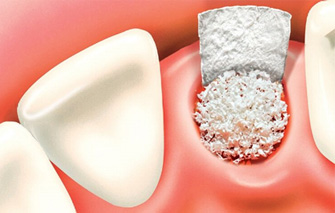 Bone Graft