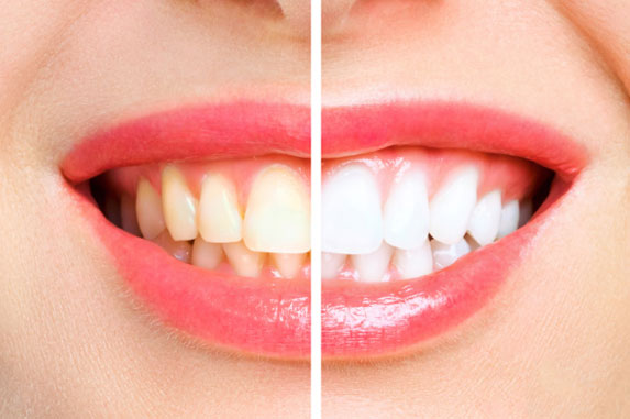 Teeth Whitening